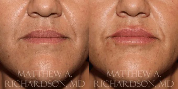 Lip Augmentation Before and After photo by Texas Facial Aesthetics in Frisco, TX