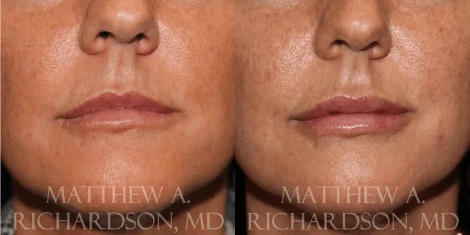 Lip Augmentation Before and After photo by Texas Facial Aesthetics in Frisco, TX