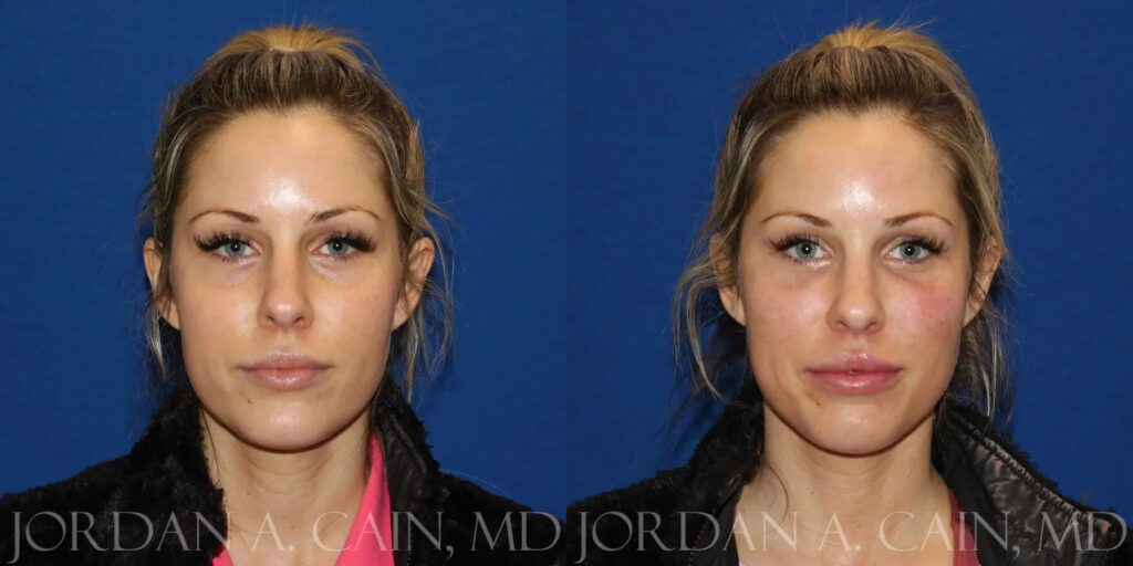 Tear Trough Filler Before and After Texas Facial Aesthetics