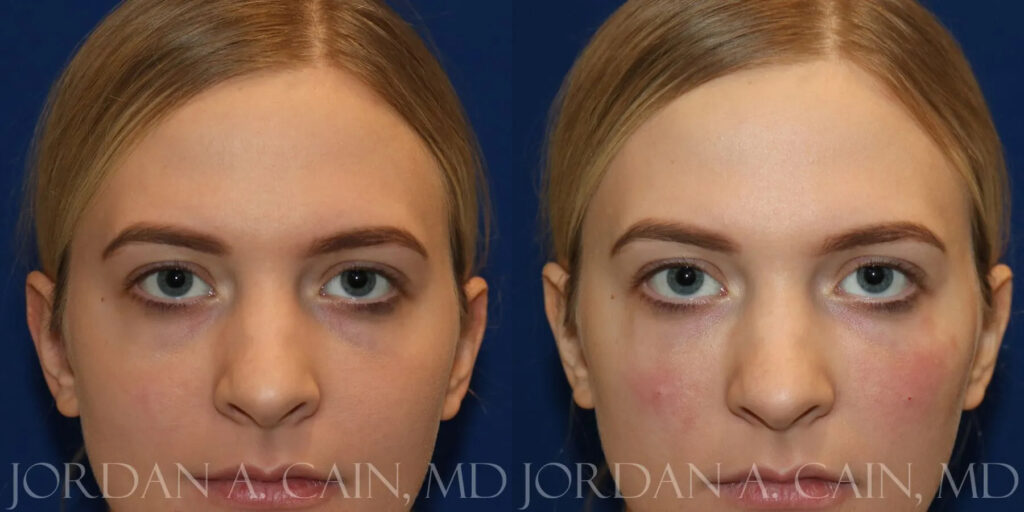 Tear Trough Filler Before and After photo by Texas Facial Aesthetics in Frisco, TX