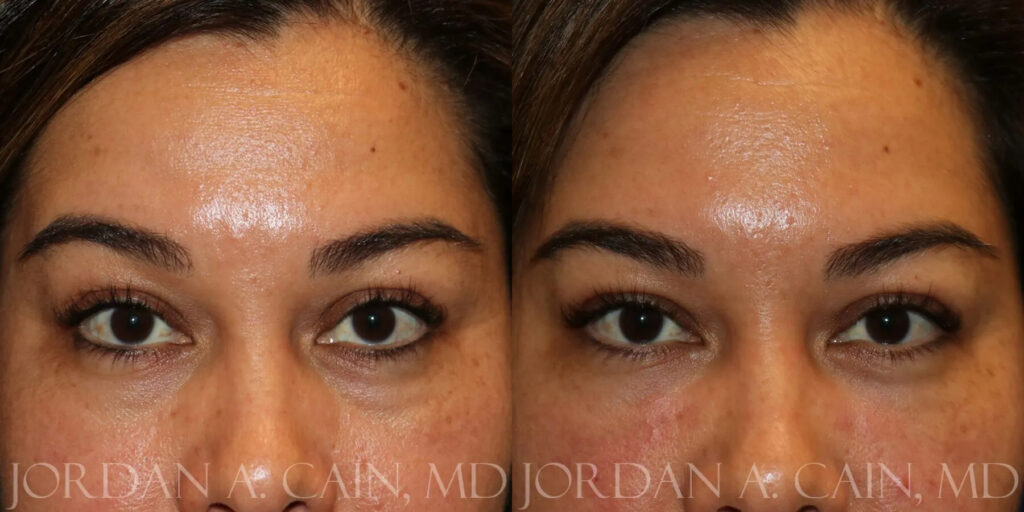 Tear Trough Filler Before and After photo by Texas Facial Aesthetics in Frisco, TX