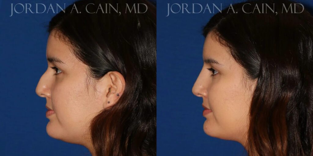 Non Surgical Nose Before and After photo by Texas Facial Aesthetics in Frisco, TX