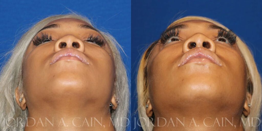 Non Surgical Nose Before and After photo by Texas Facial Aesthetics in Frisco, TX