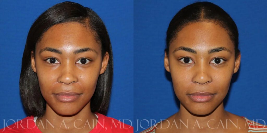 Non Surgical Nose Before and After photo by Texas Facial Aesthetics in Frisco, TX