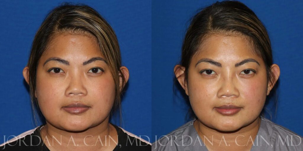 Non Surgical Nose Before and After photo by Texas Facial Aesthetics in Frisco, TX