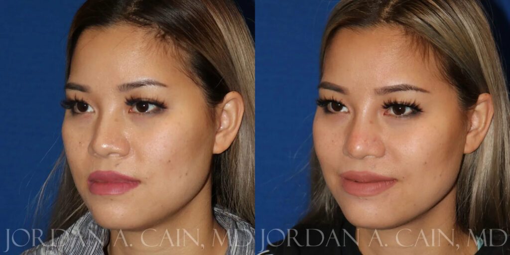 Non Surgical Nose Before and After photo by Texas Facial Aesthetics in Frisco, TX