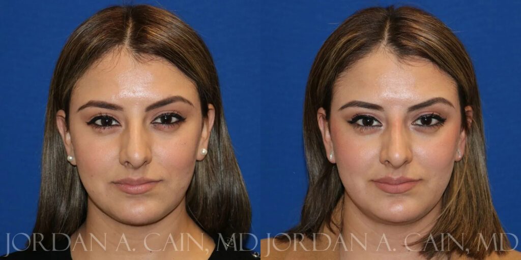 Non Surgical Nose Before and After photo by Texas Facial Aesthetics in Frisco, TX