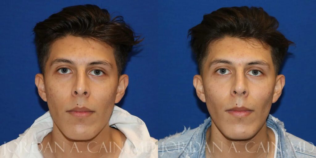 Non Surgical Nose Before and After photo by Texas Facial Aesthetics in Frisco, TX