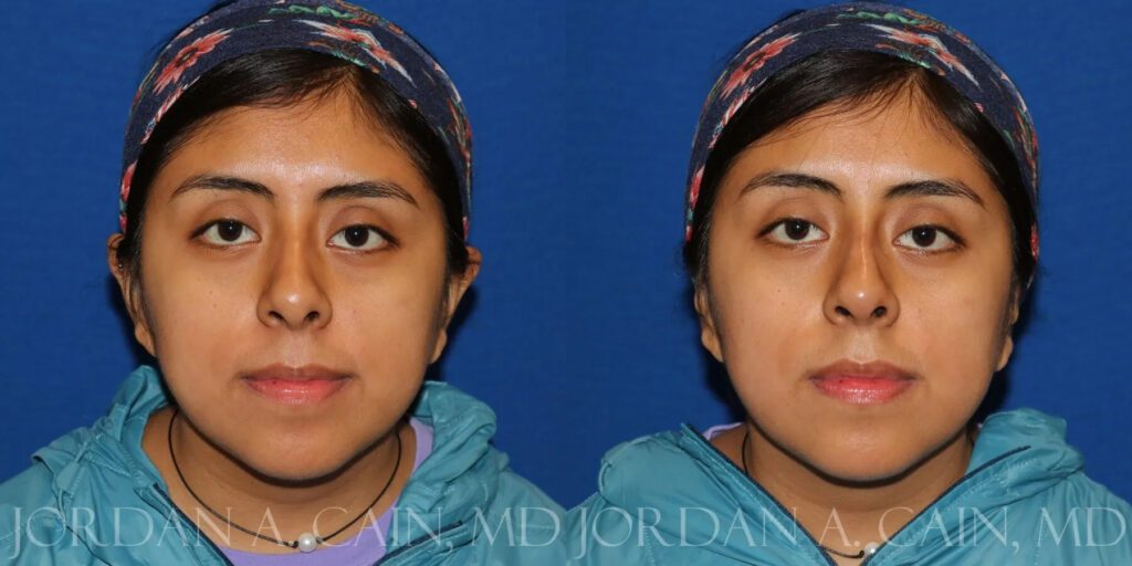 Non Surgical Nose Before and After photo by Texas Facial Aesthetics in Frisco, TX