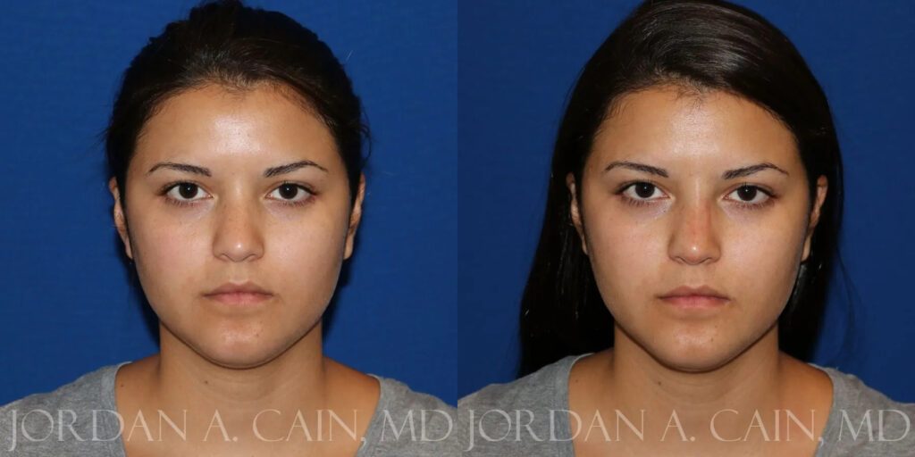 Non Surgical Nose Before and After photo by Texas Facial Aesthetics in Frisco, TX