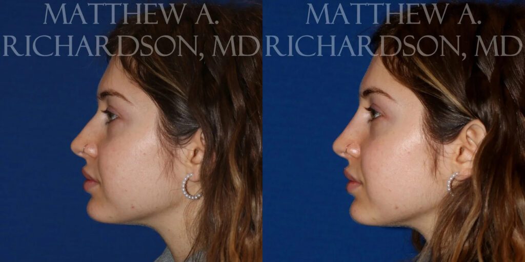 Non Surgical Nose Before and After photo by Texas Facial Aesthetics in Frisco, TX