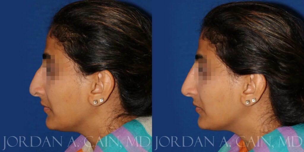 Non Surgical Nose Before and After photo by Texas Facial Aesthetics in Frisco, TX