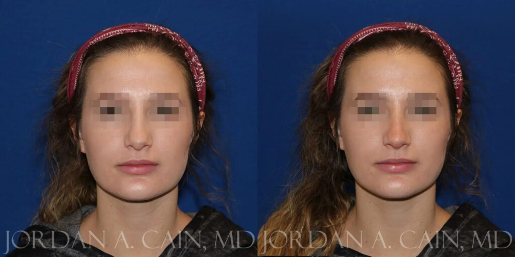 Non Surgical Nose Before and After photo by Texas Facial Aesthetics in Frisco, TX