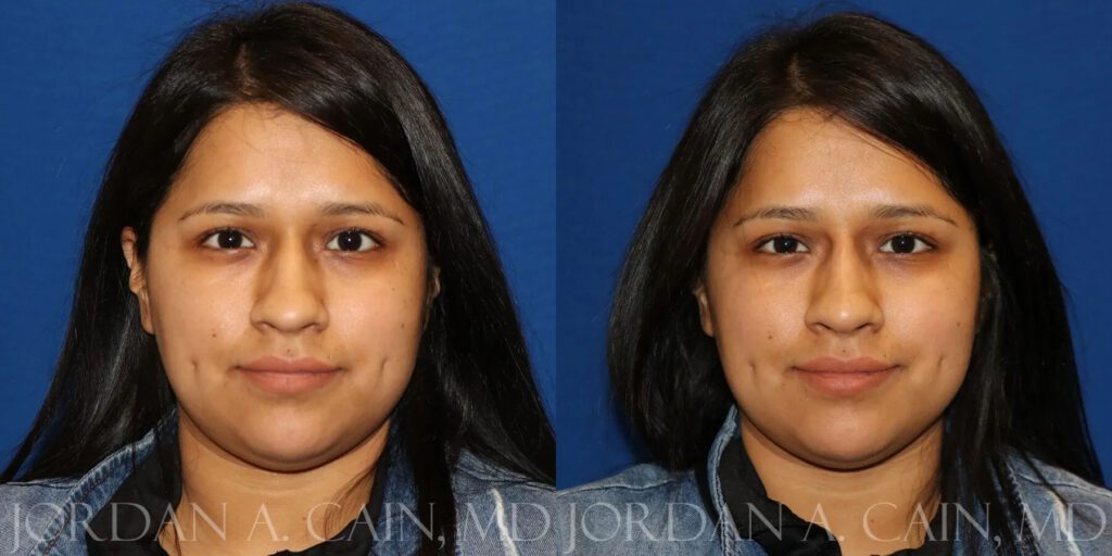 Non Surgical Nose Before and After photo by Texas Facial Aesthetics in Frisco, TX