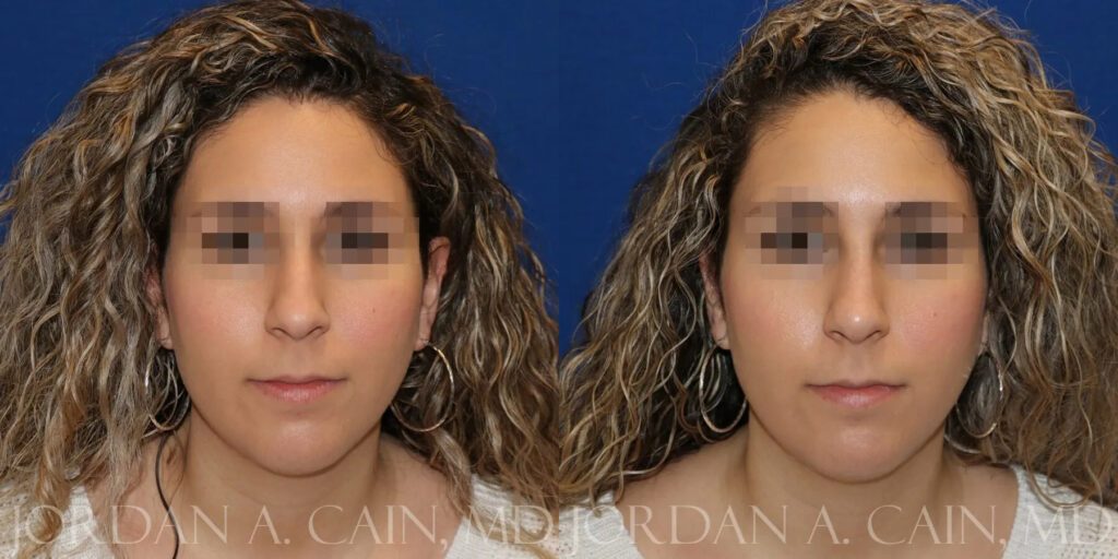 Non Surgical Nose Before and After photo by Texas Facial Aesthetics in Frisco, TX