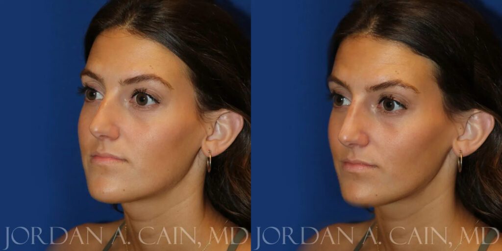 Non Surgical Nose Before and After photo by Texas Facial Aesthetics in Frisco, TX