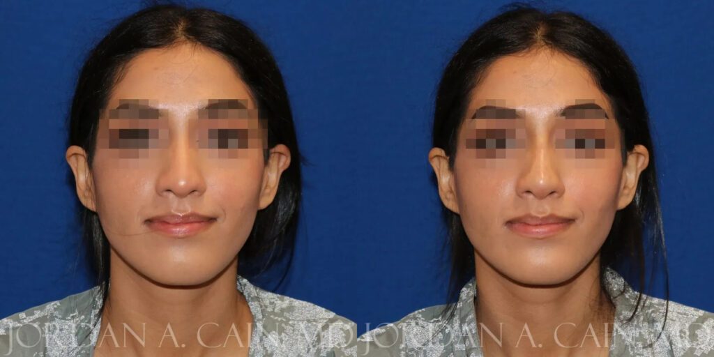 Non Surgical Nose Before and After photo by Texas Facial Aesthetics in Frisco, TX