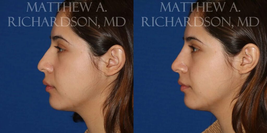 Non Surgical Nose Before and After photo by Texas Facial Aesthetics in Frisco, TX