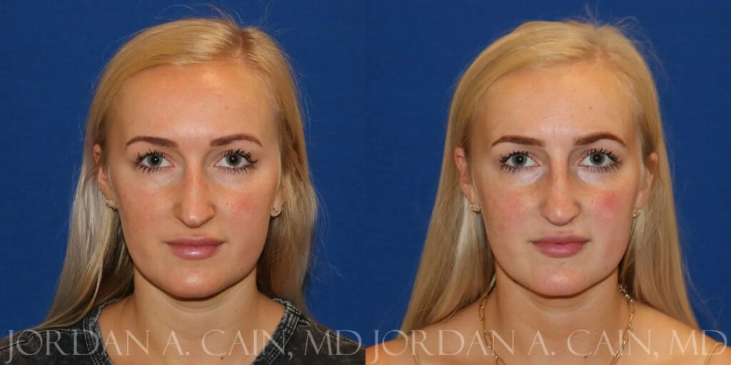 Non Surgical Nose Before and After photo by Texas Facial Aesthetics in Frisco, TX