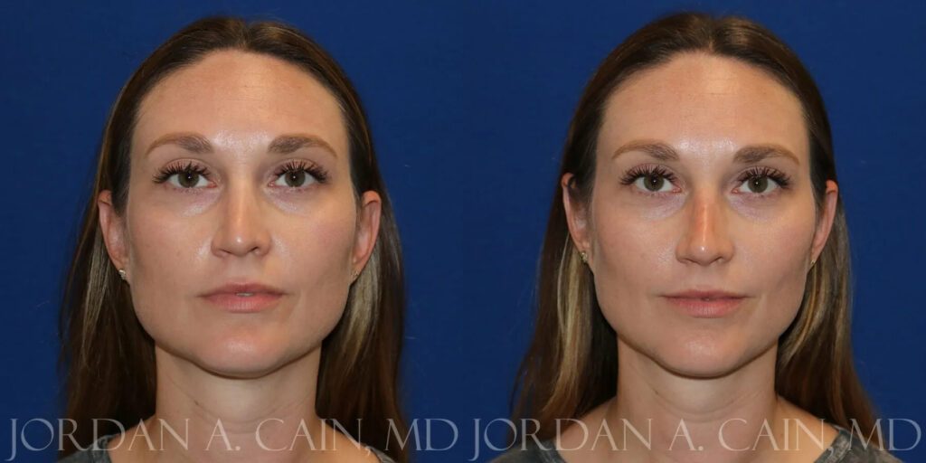 Non Surgical Nose Before and After photo by Texas Facial Aesthetics in Frisco, TX