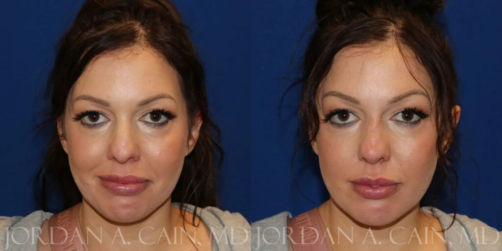 Non Surgical Nose Before and After photo by Texas Facial Aesthetics in Frisco, TX