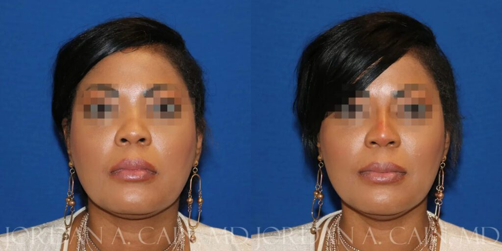 Non Surgical Nose Before and After photo by Texas Facial Aesthetics in Frisco, TX