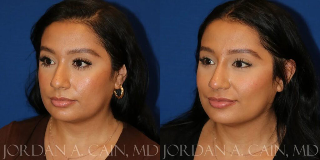 Non Surgical Nose Before and After photo by Texas Facial Aesthetics in Frisco, TX