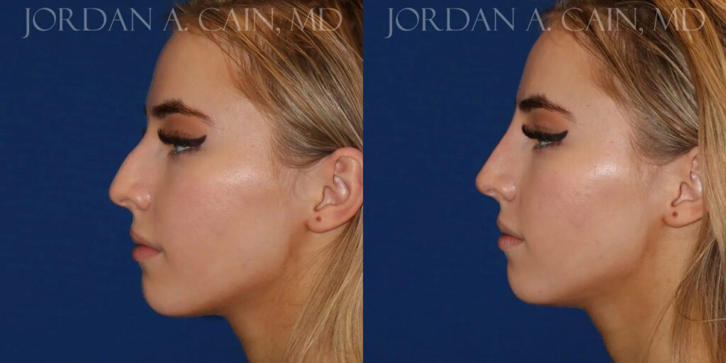 Non Surgical Nose Before and After photo by Texas Facial Aesthetics in Frisco, TX