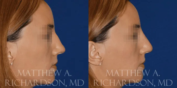 Non Surgical Nose Before and After photo by Texas Facial Aesthetics in Frisco, TX