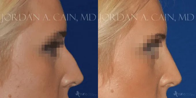 Non Surgical Nose Before and After photo by Texas Facial Aesthetics in Frisco, TX