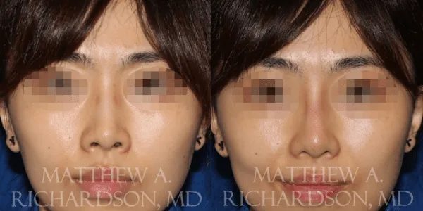 Non Surgical Nose Before and After photo by Texas Facial Aesthetics in Frisco, TX