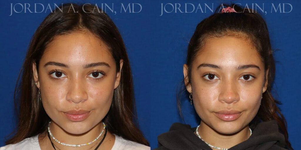 Non Surgical Nose Before and After photo by Texas Facial Aesthetics in Frisco, TX