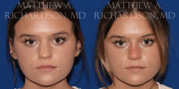 Non Surgical Nose Before and After photo by Texas Facial Aesthetics in Frisco, TX