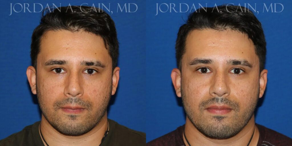 Non Surgical Nose Before and After photo by Texas Facial Aesthetics in Frisco, TX