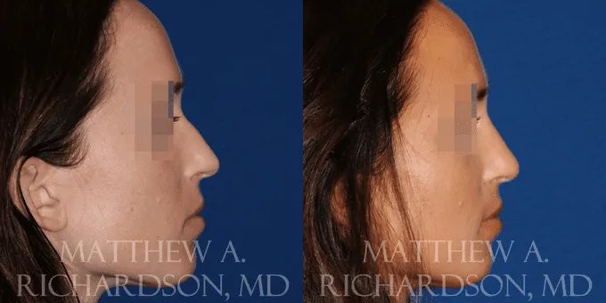 Non Surgical Nose Before and After photo by Texas Facial Aesthetics in Frisco, TX