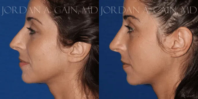 Non Surgical Nose Before and After photo by Texas Facial Aesthetics in Frisco, TX