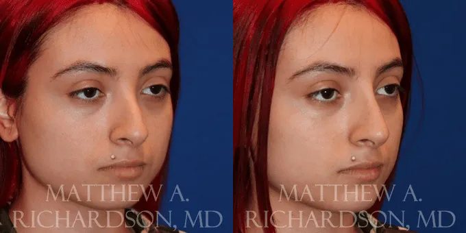 Non Surgical Nose Before and After photo by Texas Facial Aesthetics in Frisco, TX