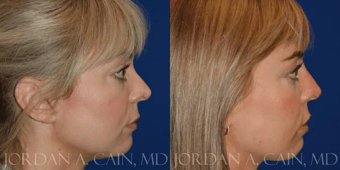 Non Surgical Nose Before and After photo by Texas Facial Aesthetics in Frisco, TX