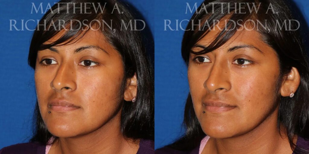 Non Surgical Nose Before and After photo by Texas Facial Aesthetics in Frisco, TX