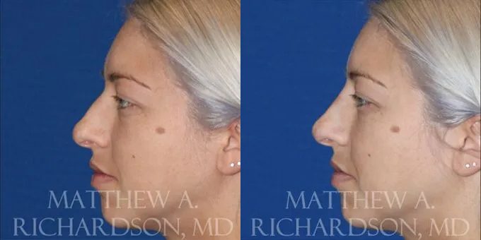 Non Surgical Nose Before and After photo by Texas Facial Aesthetics in Frisco, TX