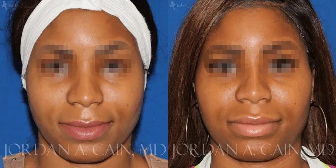 Non Surgical Nose Before and After photo by Texas Facial Aesthetics in Frisco, TX