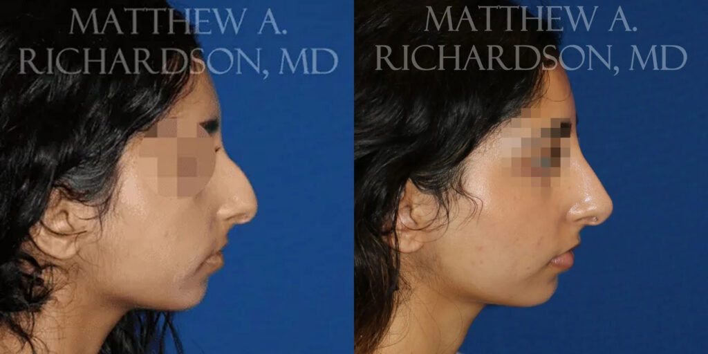 Non Surgical Nose Before and After photo by Texas Facial Aesthetics in Frisco, TX