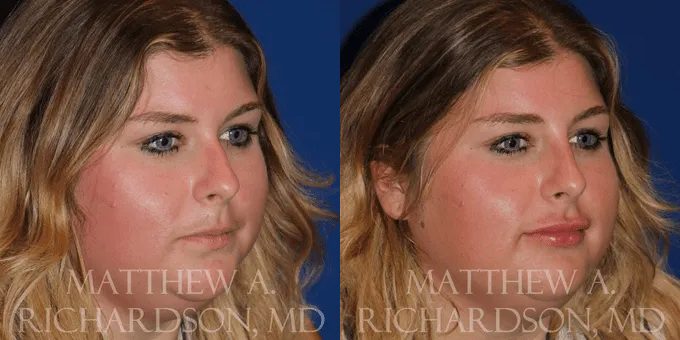 Non Surgical Nose Before and After photo by Texas Facial Aesthetics in Frisco, TX