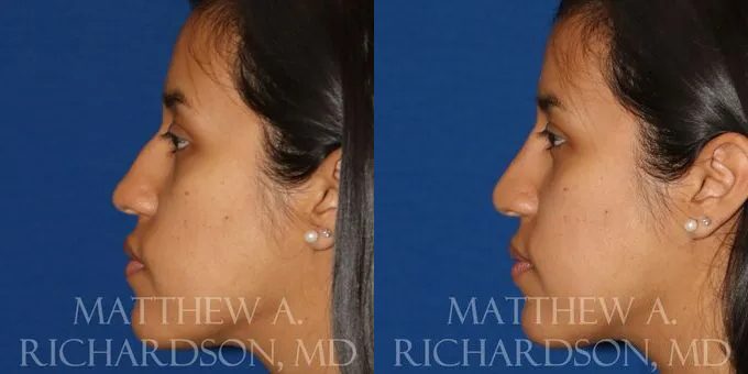 Non Surgical Nose Before and After photo by Texas Facial Aesthetics in Frisco, TX