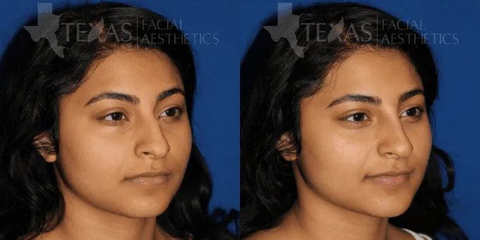 Non Surgical Nose Before and After photo by Texas Facial Aesthetics in Frisco, TX