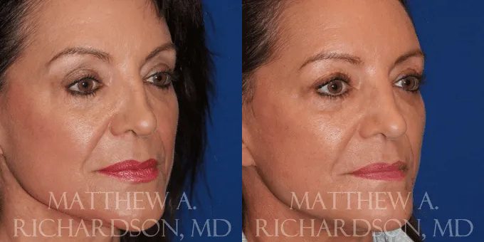 Non Surgical Nose Before and After photo by Texas Facial Aesthetics in Frisco, TX