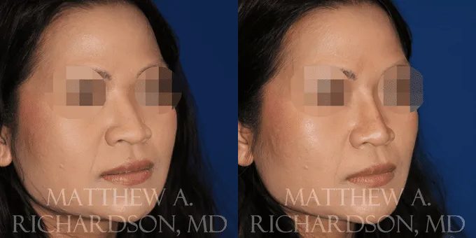 Non Surgical Nose Before and After photo by Texas Facial Aesthetics in Frisco, TX