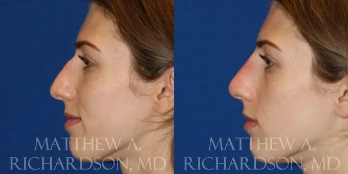 Non Surgical Nose Before and After photo by Texas Facial Aesthetics in Frisco, TX