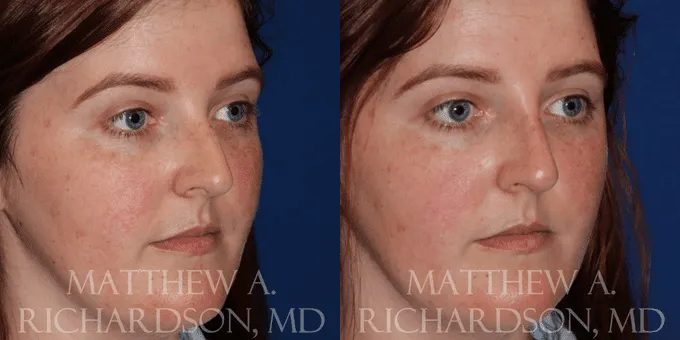 Non Surgical Nose Before and After photo by Texas Facial Aesthetics in Frisco, TX