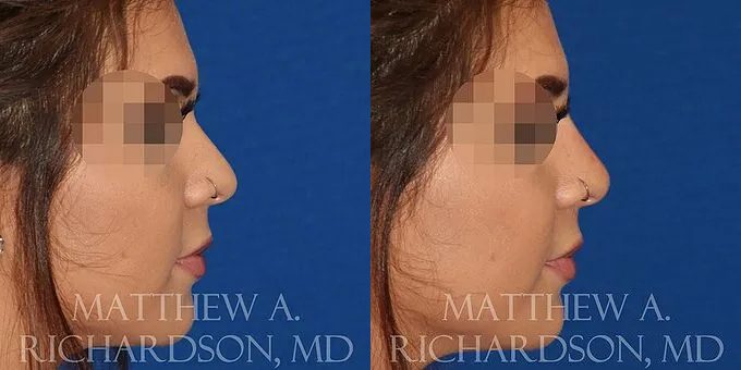 Non Surgical Nose Before and After photo by Texas Facial Aesthetics in Frisco, TX